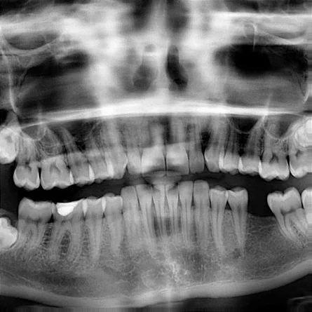 El problema de apretar los dientes o bruxismo